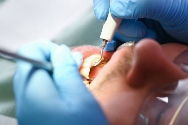 Best Emergency Tooth Extraction in Myers Corner, NY